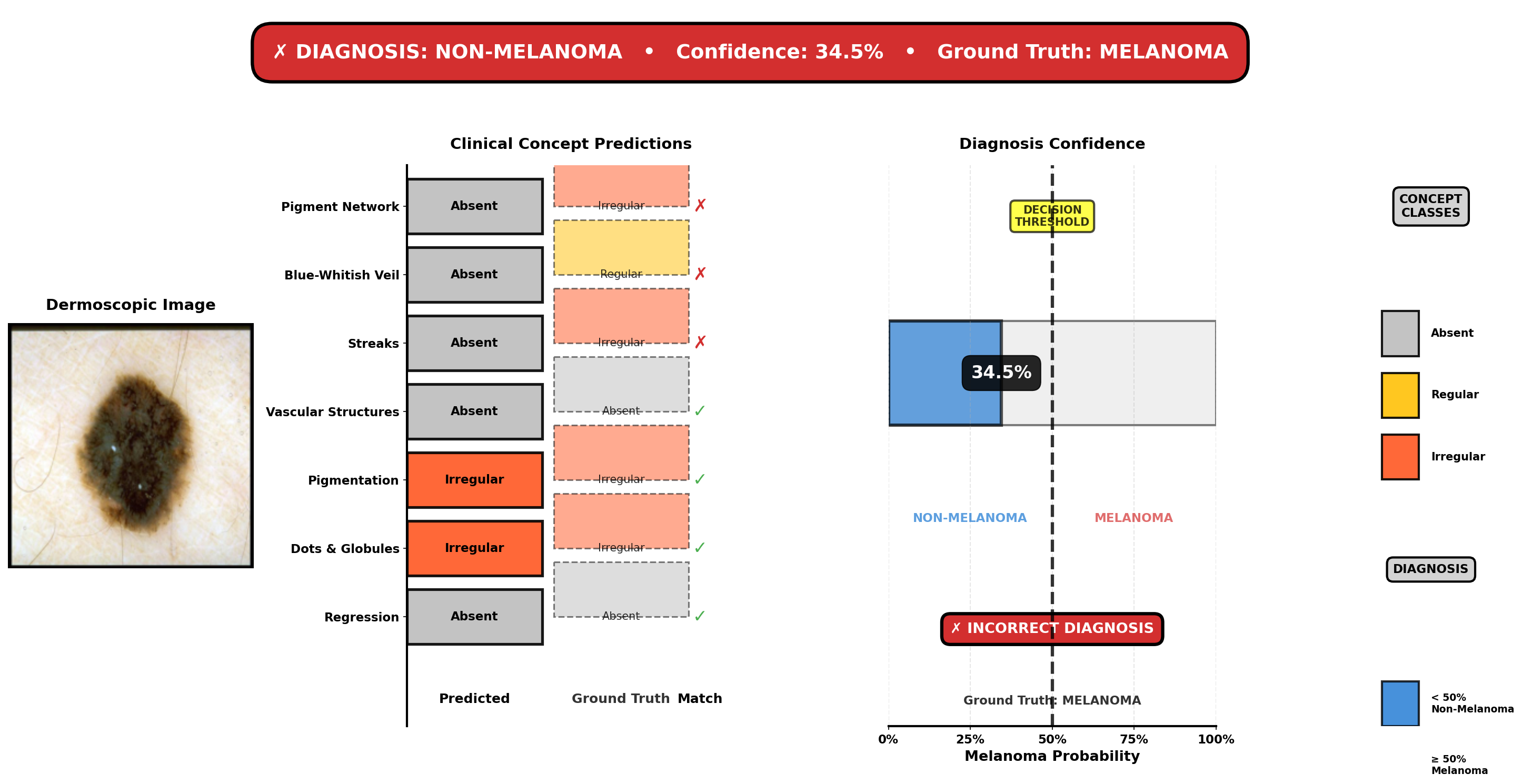 Case 578: Melanoma with high 7-point score