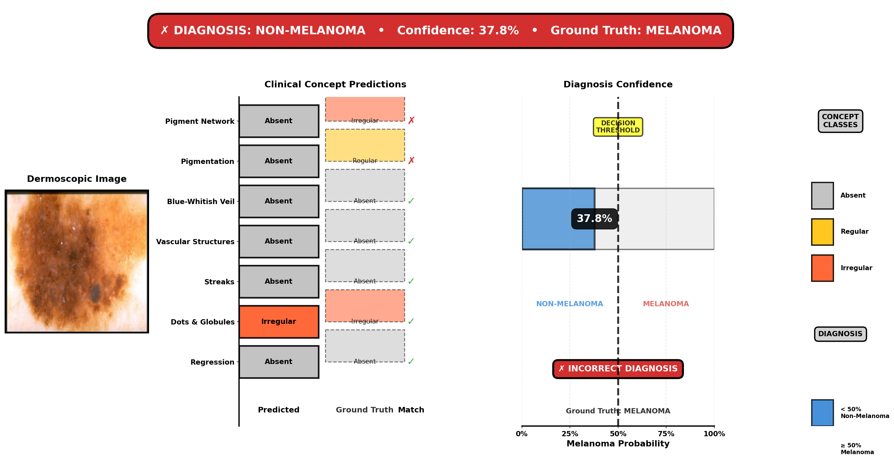 Case 596: Melanoma with moderate features